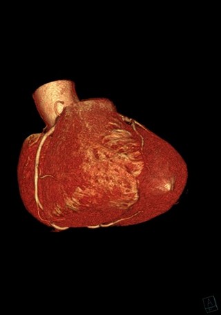 Artère coronaire droite 3D
