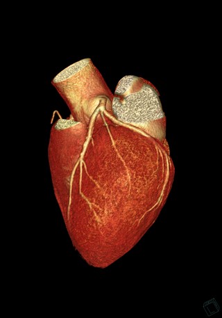Artère interventriculaire gauche et artère circonflexe 3D
