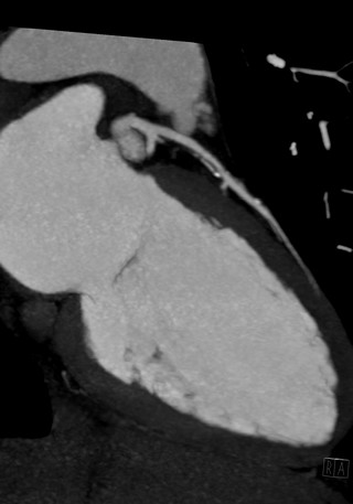 Artère interventriculaire gauche